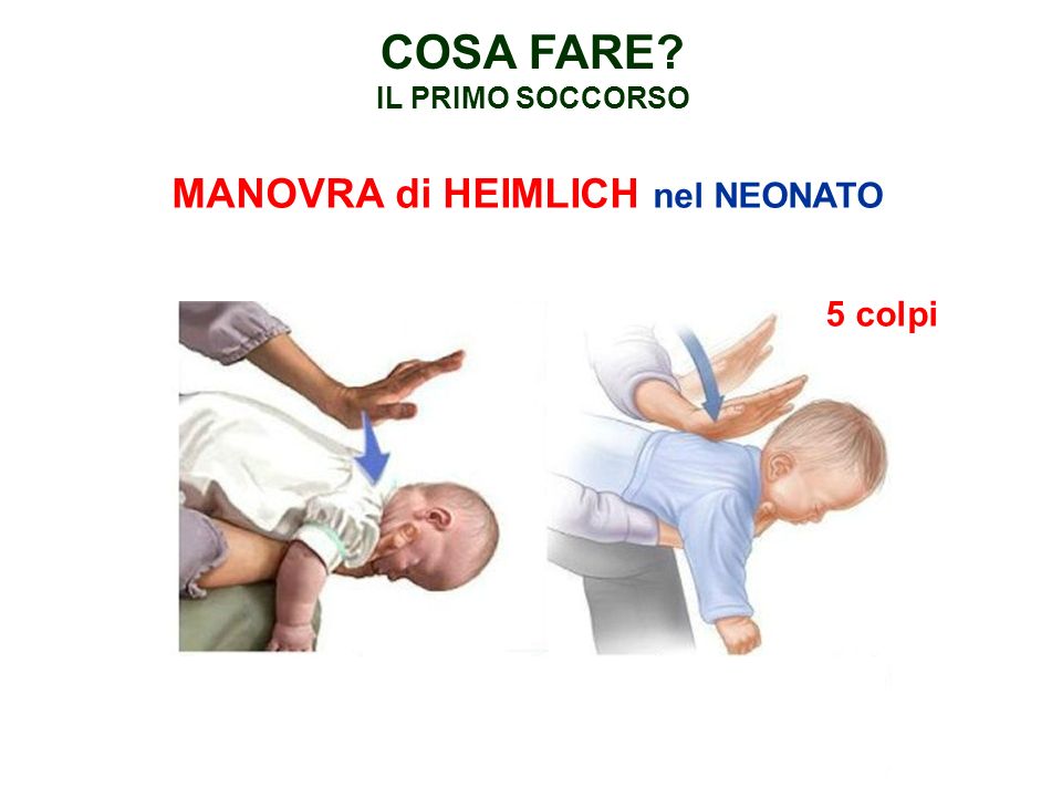 manovra Heimlich
